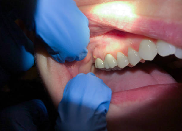 Best Emergency Tooth Extraction in Lacoste, TX